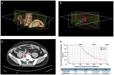 Frontiers Feasibility And Clinical Value Of CT Guided 125I